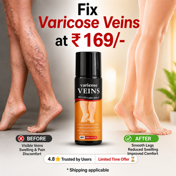 Varicose Veins Spray